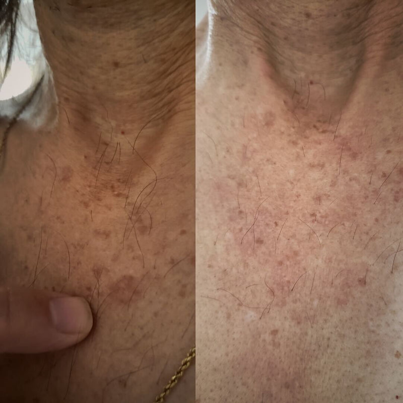 BioFormula Select  Kojic Acid Body Wash - Body Wash That Helps Lighten Dark Spots, Discoloration, Sun Spots, Age Spots & Post-Acne Marks, (1 pk, 30g)