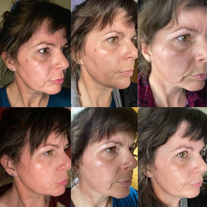 Fast Dark Spot Remover / Color Correction Fade Exfoliator, Safe Home Treatment for Hyperpigmentation & Melasma, Hydroquinone Maximum Strength