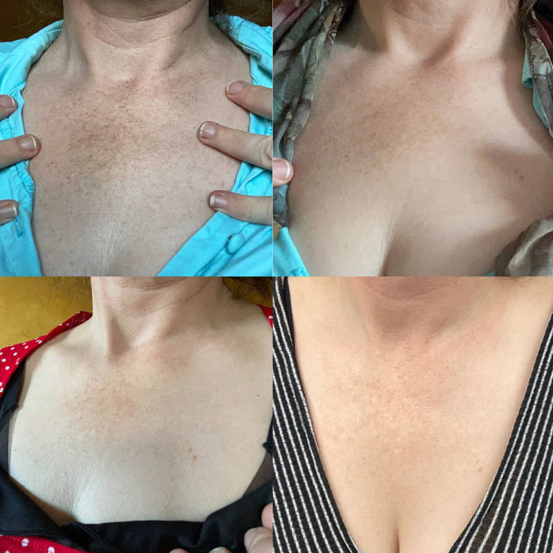 BioFormula Select  Kojic Acid Body Wash - Body Wash That Helps Lighten Dark Spots, Discoloration, Sun Spots, Age Spots & Post-Acne Marks, (1 pk, 30g)