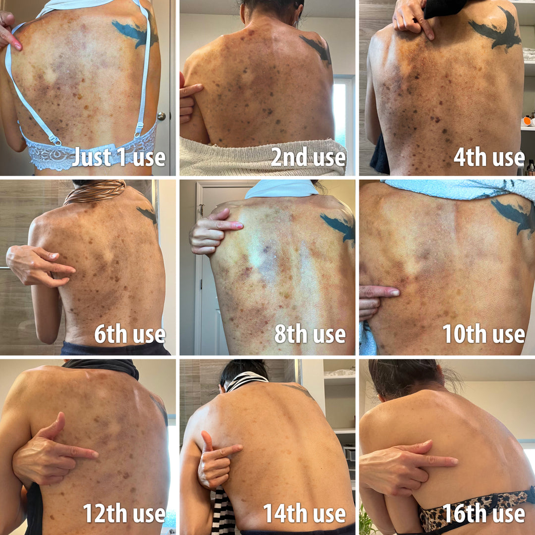 Kurkuma Seife Mit Kojic Acid – 3 Stück, Gegen Dunkle Flecken, Zum Aufhellen & Für Strahlende Haut (für Gesicht & Körper)