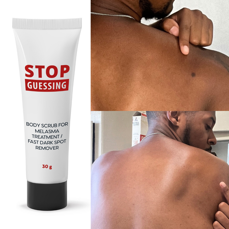 Stop Guessing Body Scrub for Fast Dark Spot Removal / Age Spot Remover, Safe Home Treatment for Hyperpigmentation & Melasma, Maximum Strength