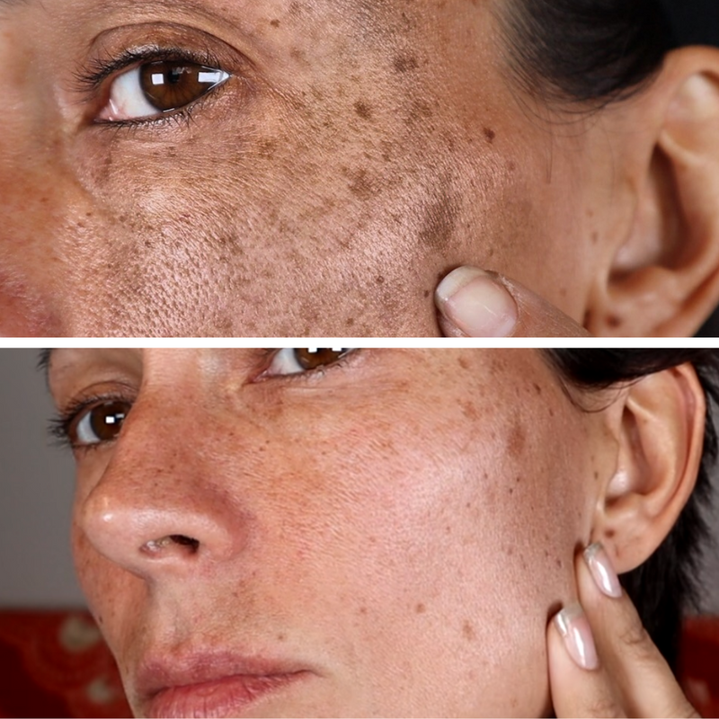 Fast Dark Spot Remover / Color Correction Fade Exfoliator, Safe Home Treatment for Hyperpigmentation & Melasma, Hydroquinone Maximum Strength