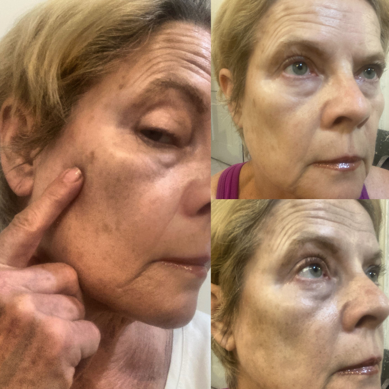 Fast Dark Spot Remover / Color Correction Fade Exfoliator, Safe Home Treatment for Hyperpigmentation & Melasma, Hydroquinone Maximum Strength