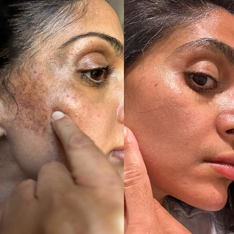 Fast Dark Spot Remover / Color Correction Fade Exfoliator, Safe Home Treatment for Hyperpigmentation & Melasma, Hydroquinone Maximum Strength