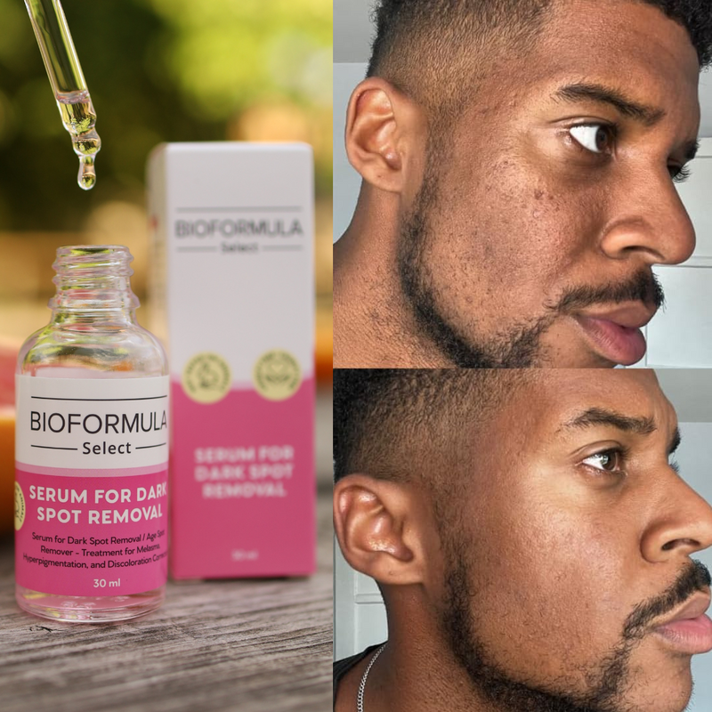 BioFormula Select Arbutin Serum That Helps Lighten Dark Spots, Discoloration, Sun Spots, Age Spots & Post-Acne Marks, With Anti-Aging Hexapeptide-1 and Oligopeptide-1, 30ML