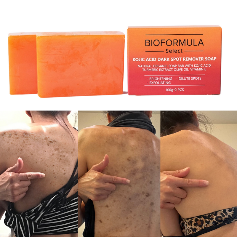 BioFormula Select Kojic Acid Dark Spot Remover Soap Bars with Vitamin C, Retinol, Collagen, Turmeric - Original Japanese Complex Infused with Hyaluronic Acid, Vitamin E, Shea Butter, Castile Olive Oil (2 Pack)