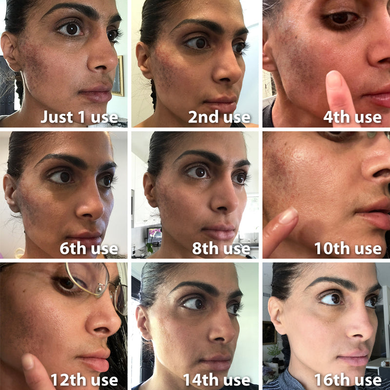 Fast Dark Spot Remover / Color Correction Fade Exfoliator, Safe Home Treatment for Hyperpigmentation & Melasma, Hydroquinone Maximum Strength