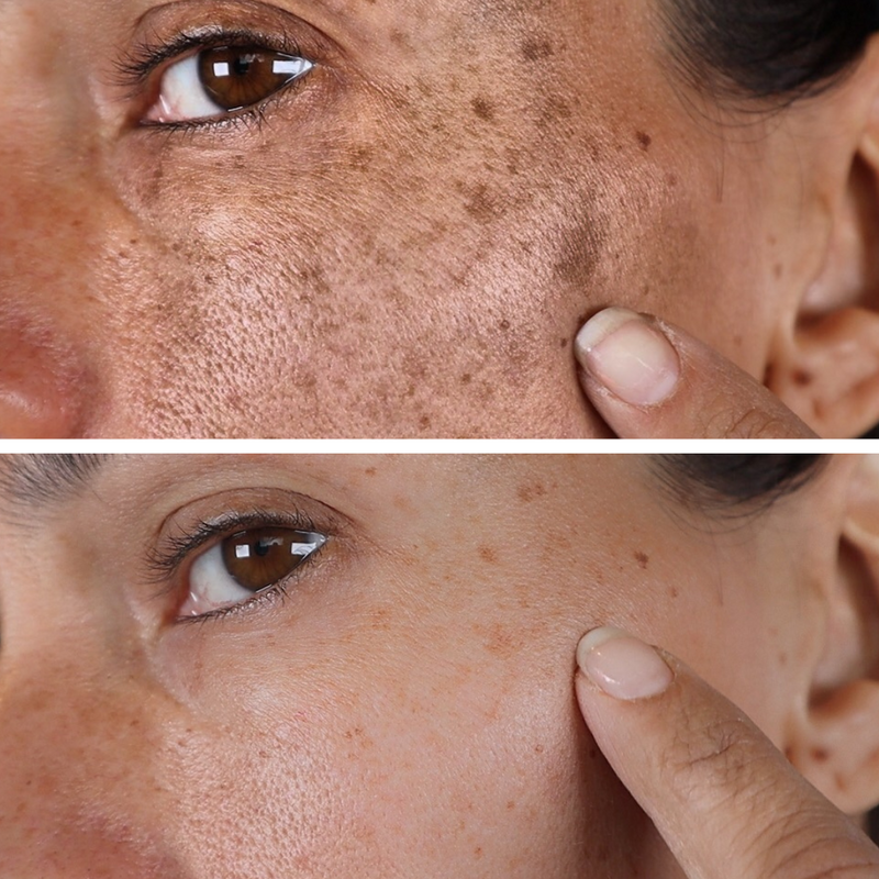 Fast Dark Spot Remover Color Correction Fade Exfoliator Safe